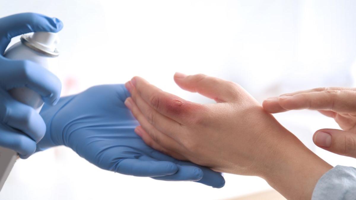 primul tratament impotriva infectiilor virale ale pielii