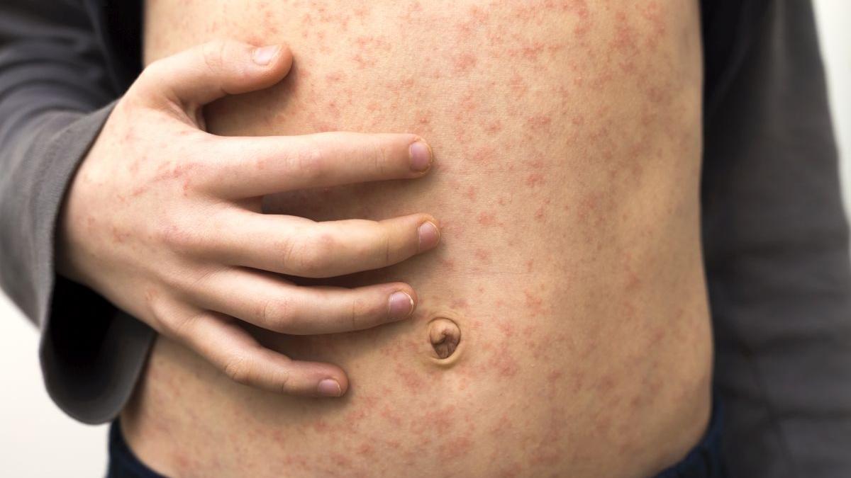 ministrul sanatatii e epidemie de rujeola a scazut vaccinarea foarte mult 20 de copii au murit