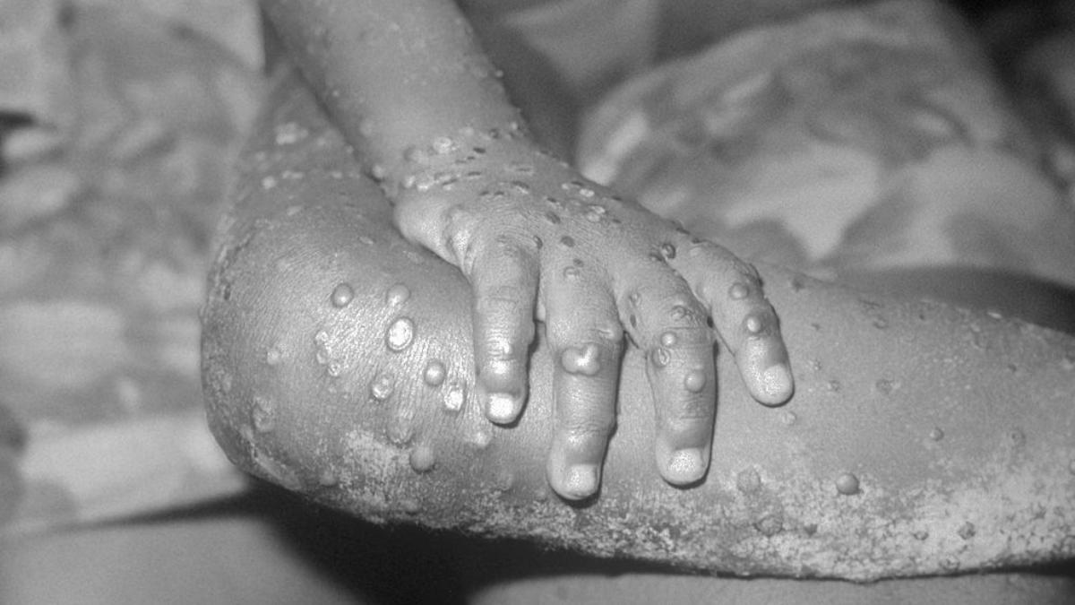 primul caz de mpox a fost inregistrat in thailanda tulpina africana confirmata la pacient e cea responsabila pentru epidemia actuala primul caz de mpox a fost inregistrat in thailanda tulpina africana confirmata la pacient e cea responsabila pentru epidemia actuala