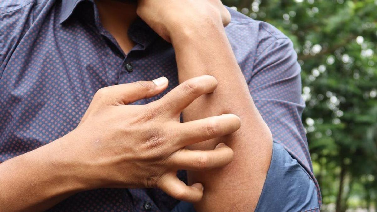 care sunt cele mai deranjante simptome cauzate de psoriazis