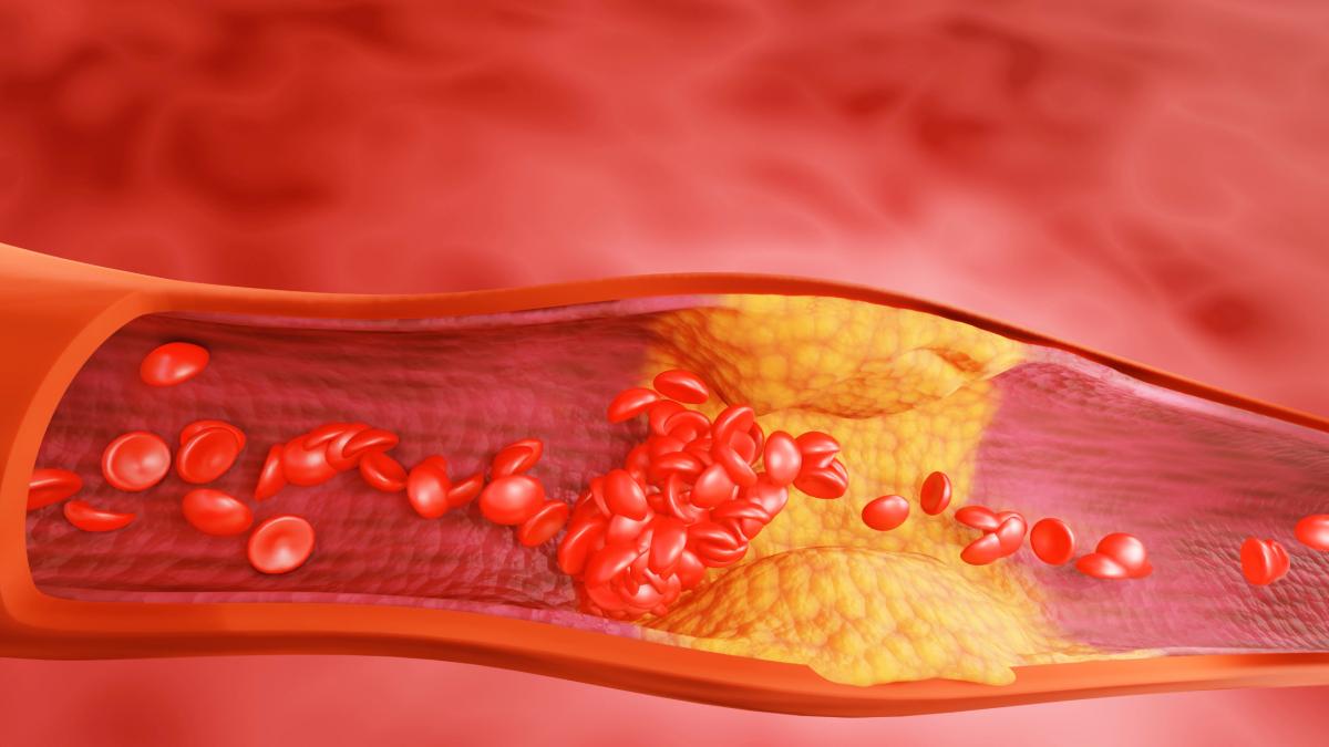 cum sa scazi colesterolul fara medicamente