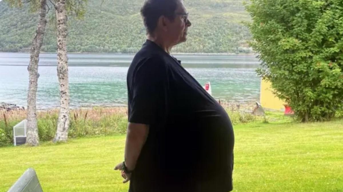 timp de 12 ani medicii i au spus unui norvegian ca este gras si i au dat ozempic avea de fapt o tumoare de 27 kg in abdomen timp de 12 ani medicii i au spus unui norvegian ca este gras si i au dat ozempic avea de fapt o tumoare de 27 kg in abdomen