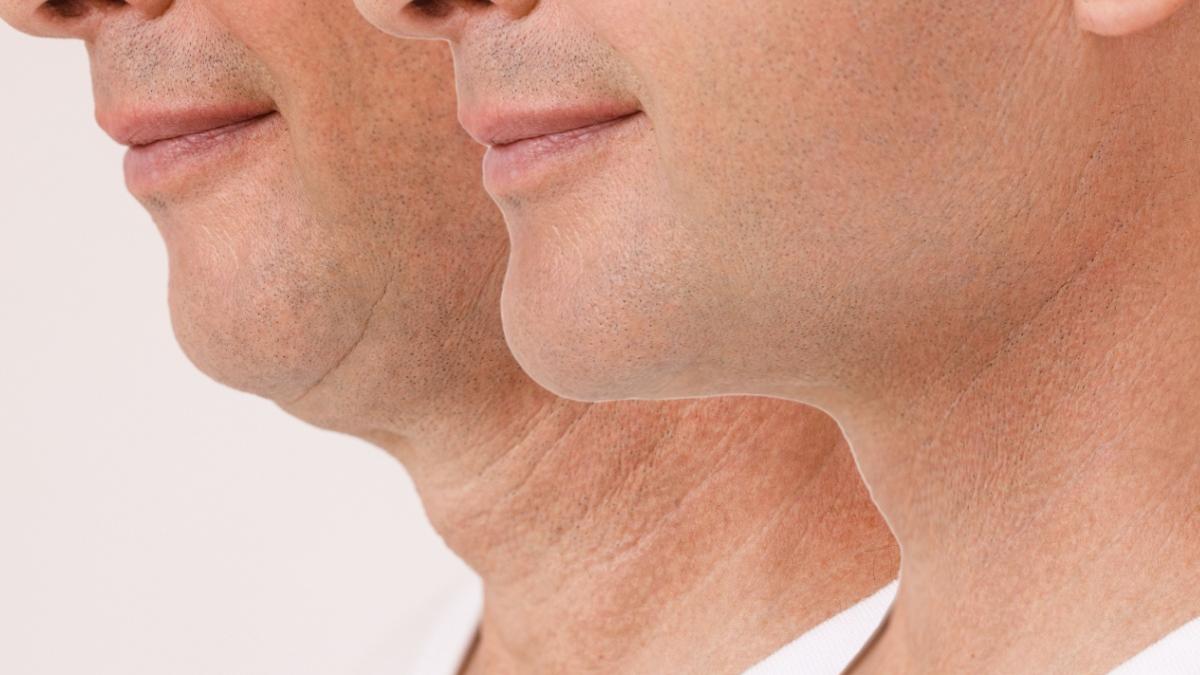 liposuctia gusei pentru barbati ce trebuie sa stii despre procedura