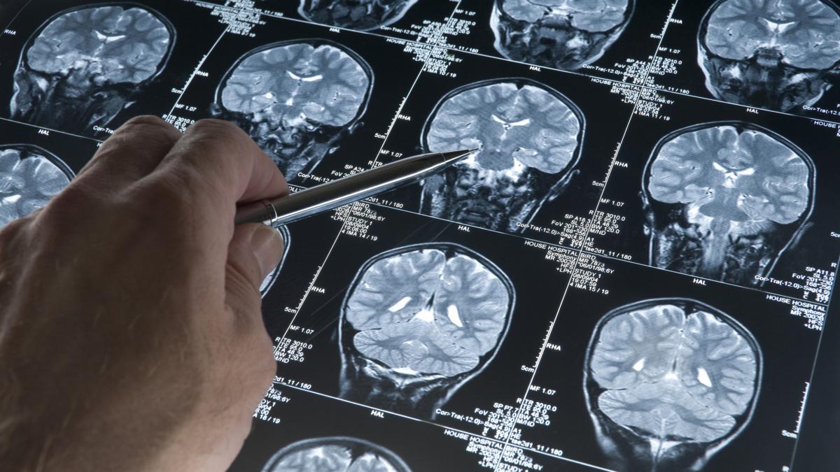 noi terapii pentru bolile neurodegenerative si solutii pentru longevitate ajuta la reactivarea neuronilor mai putin activi
