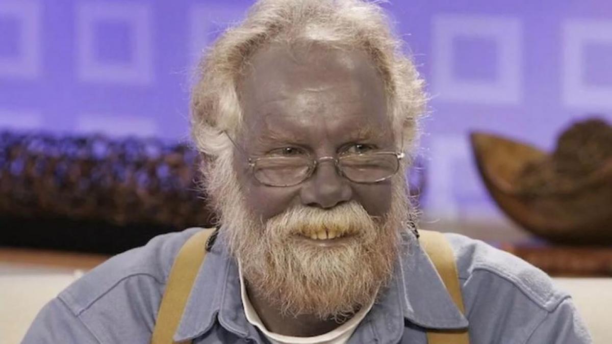 ce este argiroza boala care face ca pielea oamenilor sa devina albastra specialistii nu au reusit sa gaseasca un tratament