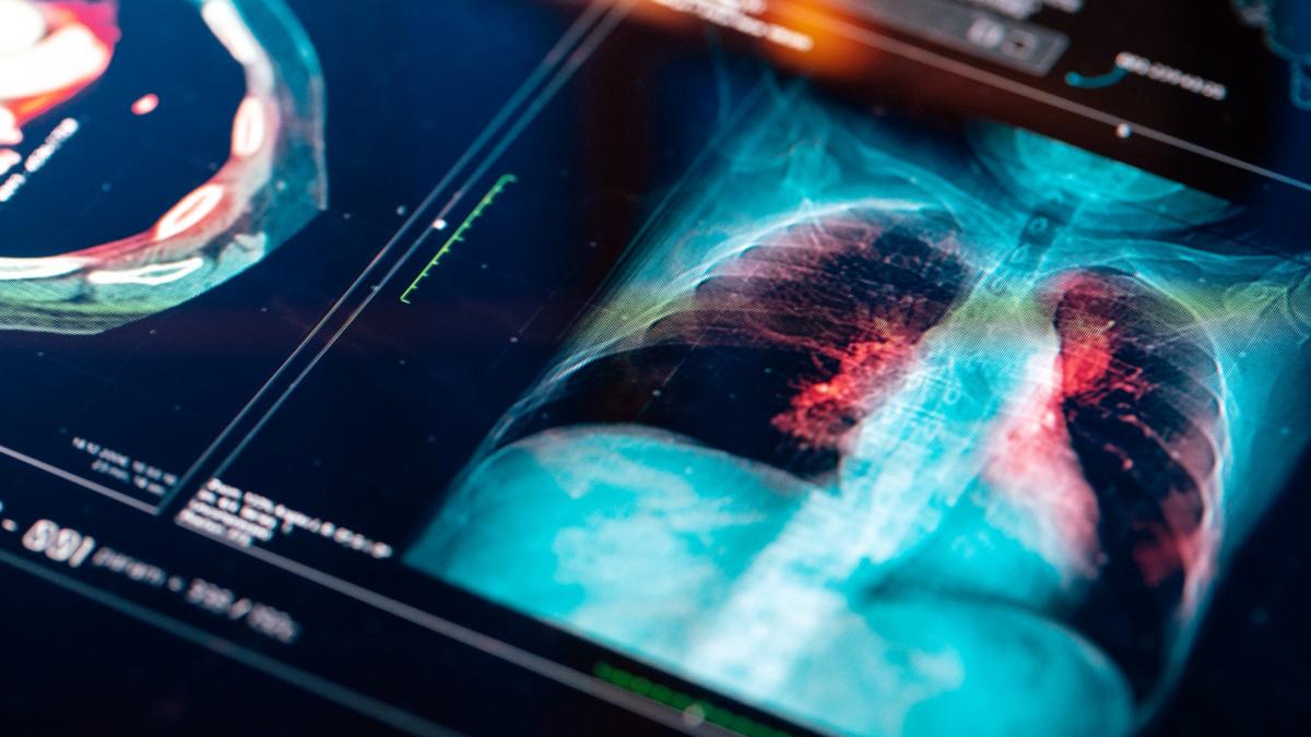 cancerul pulmonar poate fi diagnosticat cu ajutorul noilor terapii ne putem castiga viata inapoi