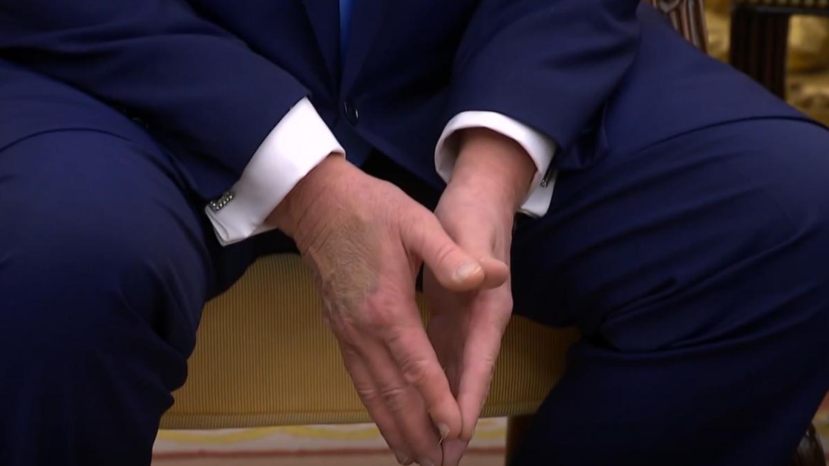 o vanataie mare pe mana lui trump isca speculatii despre starea lui de sanatate casa alba trebuie sa dea mana cu multe persoane