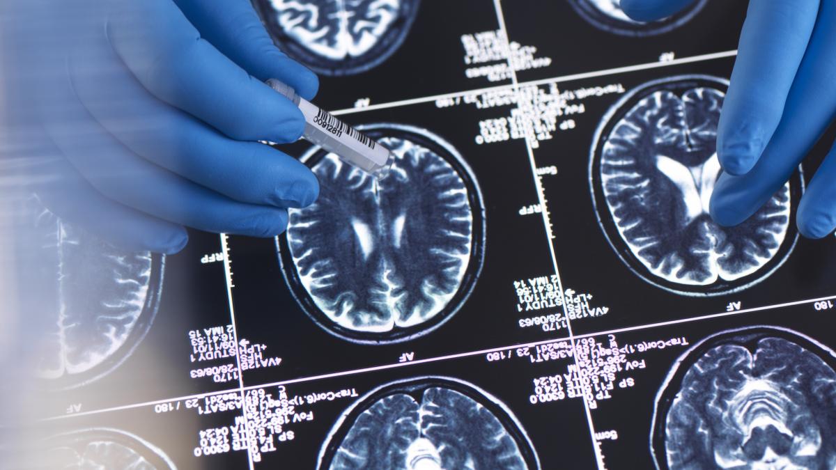 povestea celui mai tanar pacient diagnosticat cu alzheimer totul a inceput la 17 ani si doctorii nu si pot explica de ce