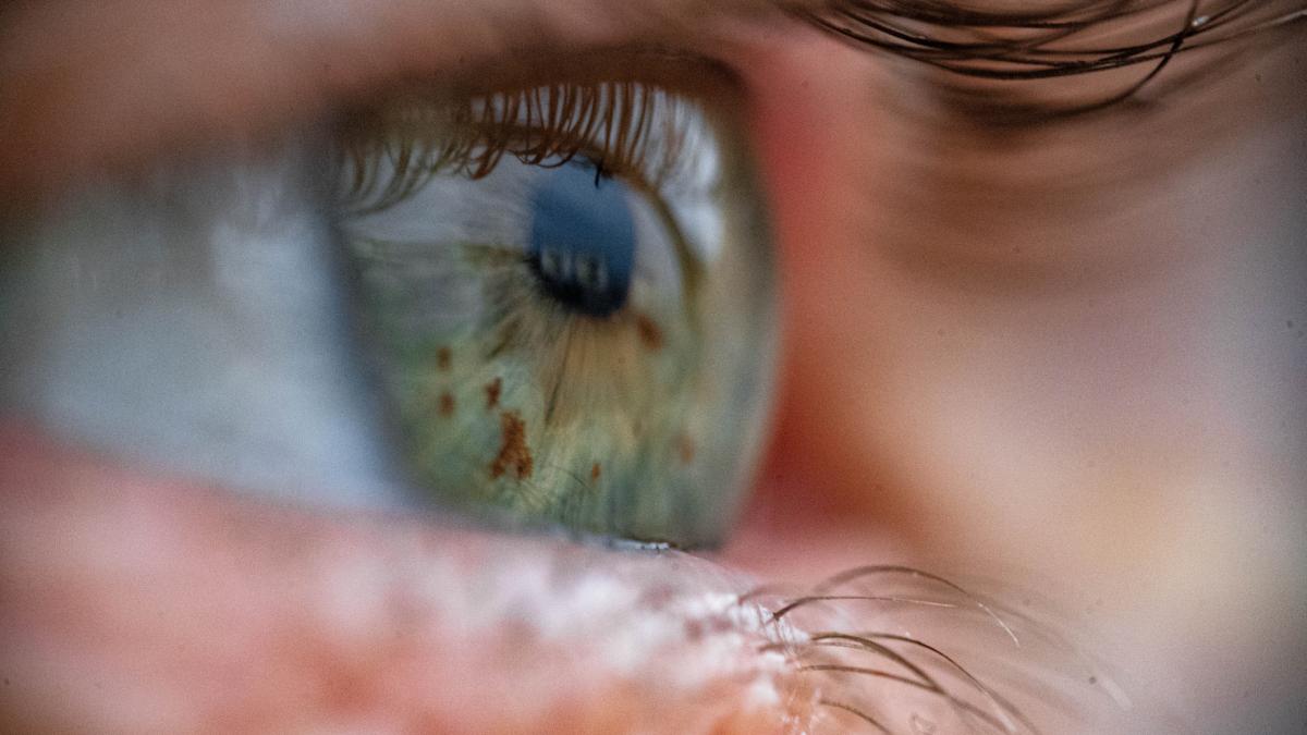 premiera medicala in italia doi frati nascuti fara iris au fost operati au putut sa isi aleaga culoarea ochilor si vad din nou