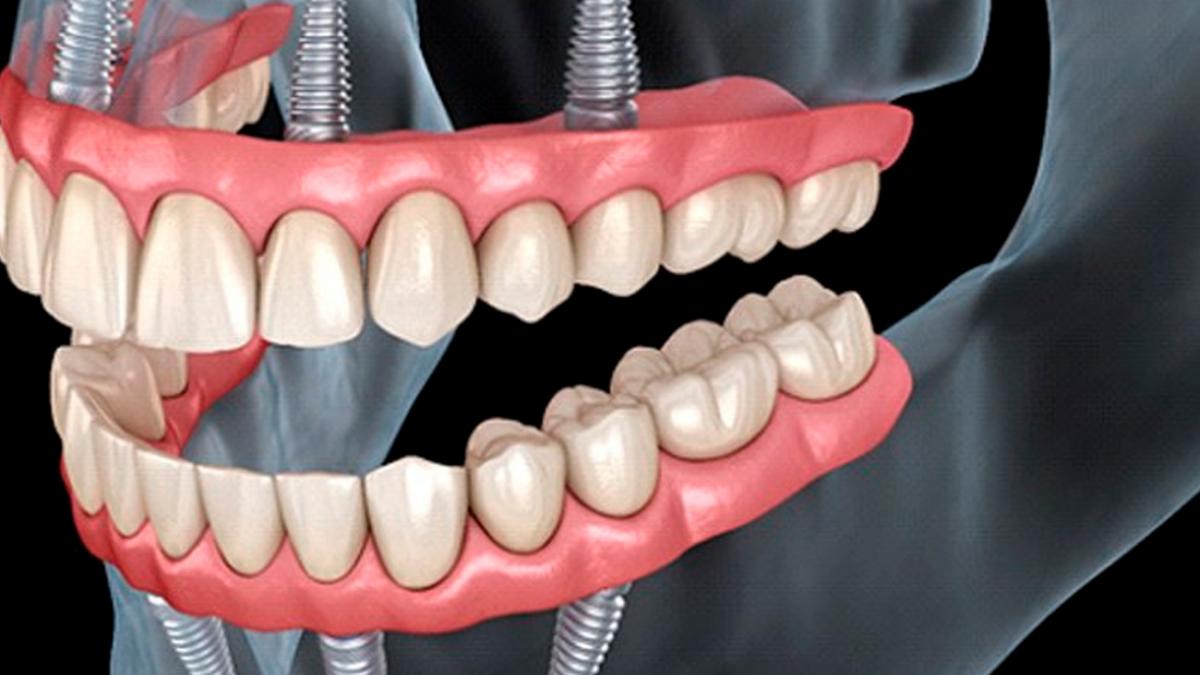 ai doar o zi atat dureaza sa ti schimbi radical viata cu dinti ficsi in 24 ore