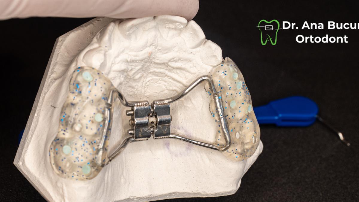 aparat dentar copii necesitate reala sau moda medicala