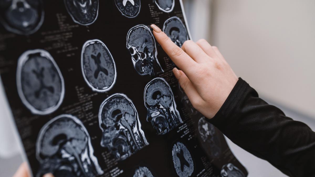 ce este epilepsia ce cauze are si cum se poate trata