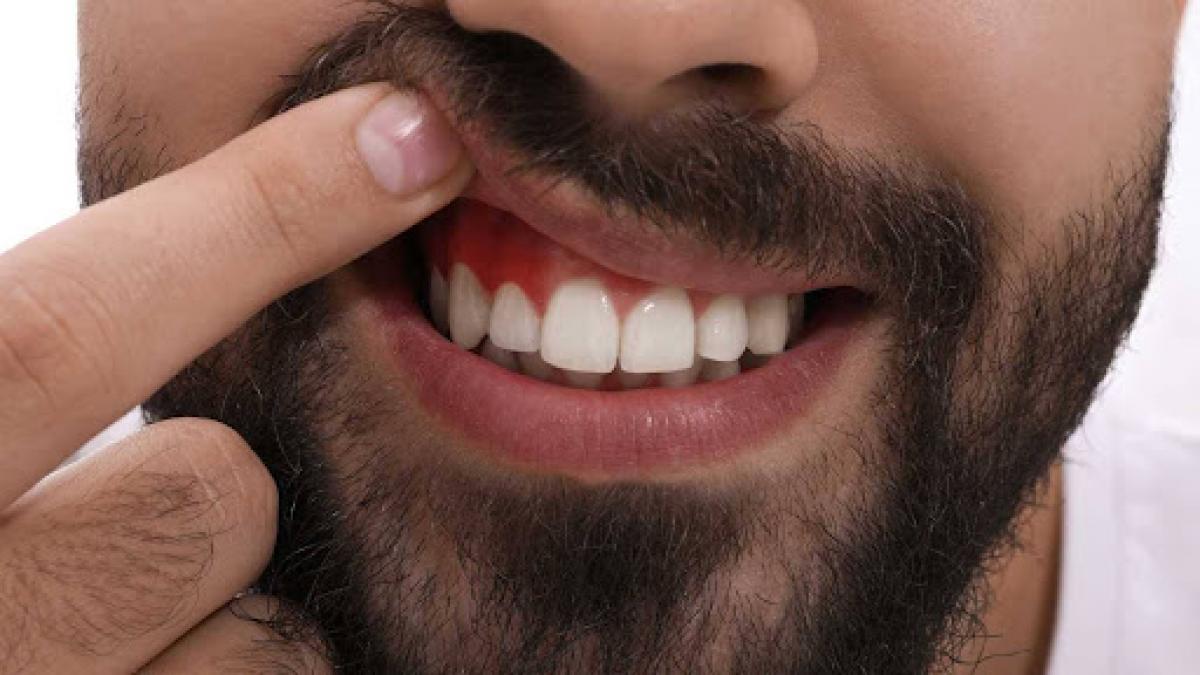 gingii inflamate sau care sangereaza afla de ce nu e normal si cum sa remediezi situatia