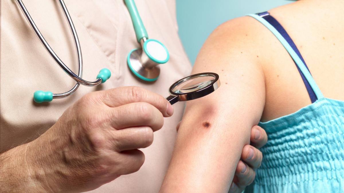 alunitele semnele unice de pe piele care pot ascunde pericole reale ce trebuie sa stim si cand sa mergem la medic