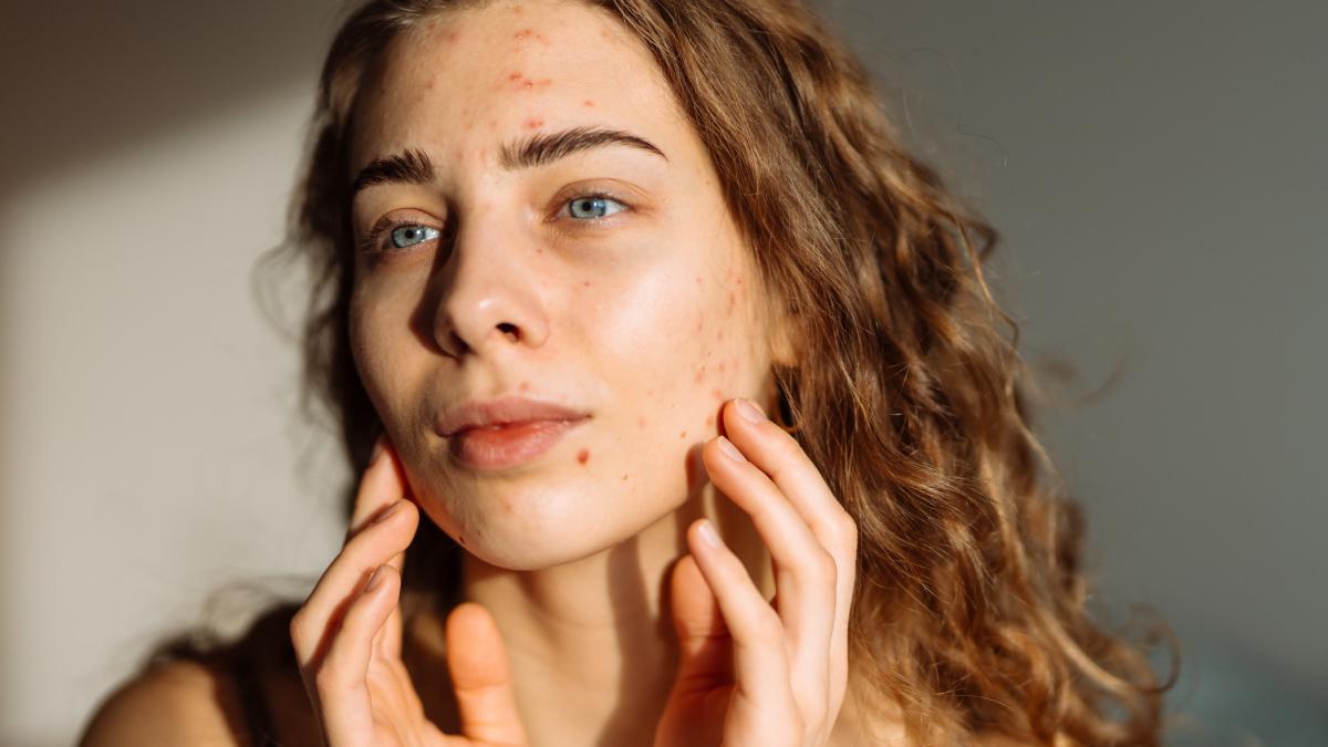 de ce se agraveaza acneea vara cele mai frecvente greseli cand e cald afara