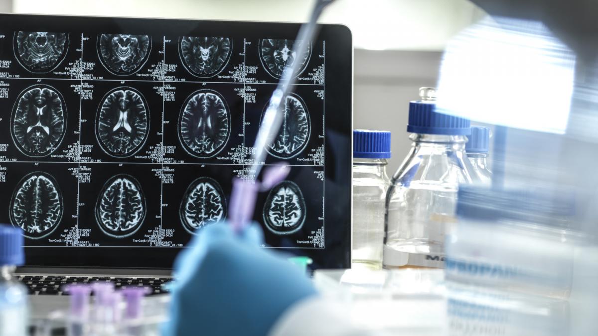 noi metode de diagnosticare precoce a bolii alzheimer in italia cercetatorii propun testarea cu nanoparticule de aur