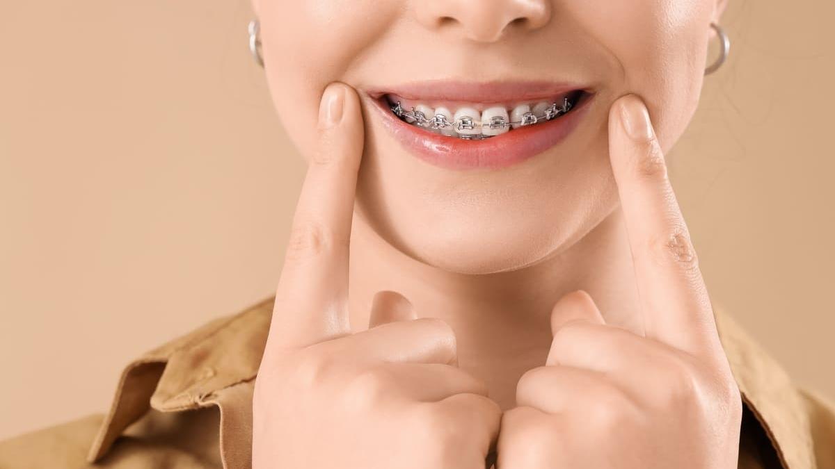 care sunt beneficiile corectarii dintilor la orice varsta cu un aparat dentar