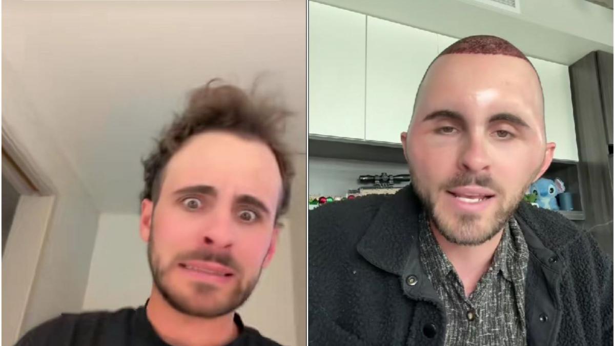 un tanar de 27 de ani si a facut implant de par dar o reactie neasteptata l a facut sa arate ca un personaj de desen animat