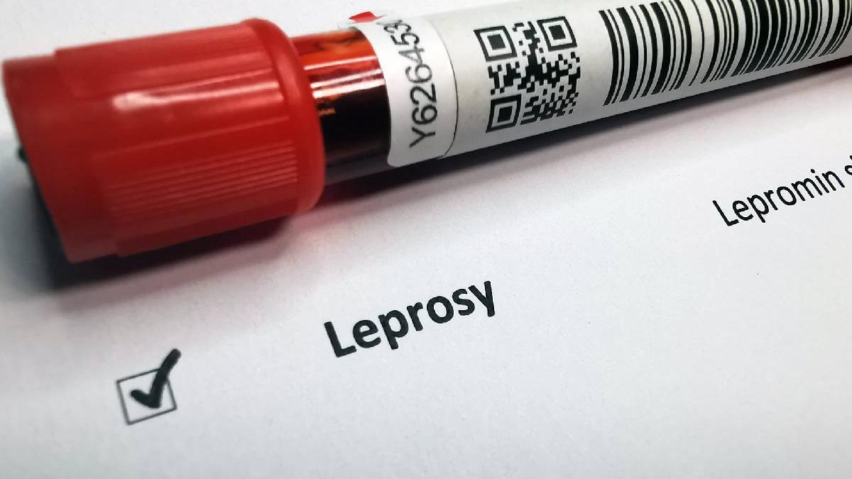 explainer lepra getty