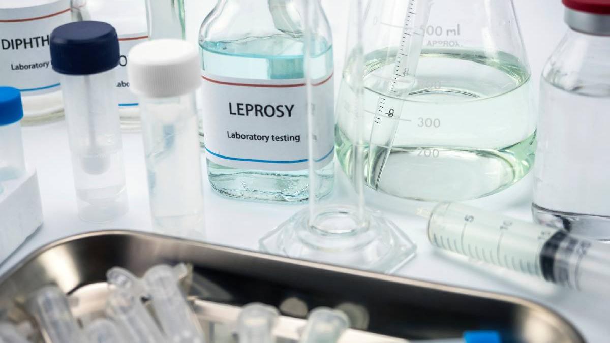 analize medicale lepra