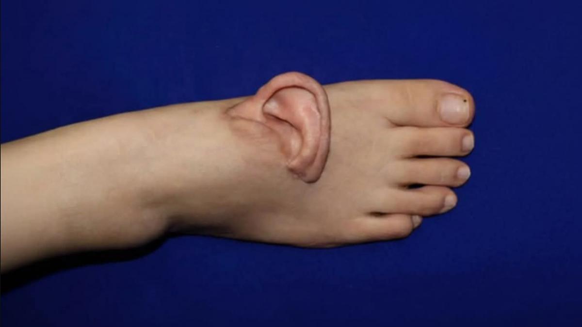 motivul pentru care o femeie din china a trait luni de zile cu o ureche atasata de picior