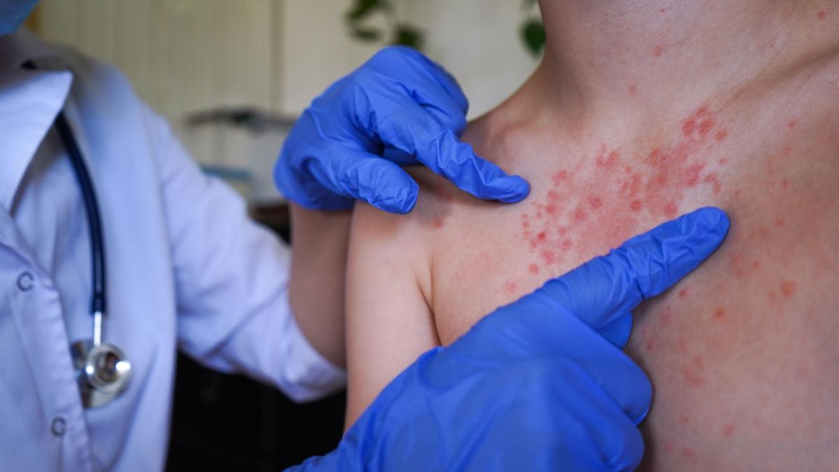 salvati copiii cea mai grava criza de vaccinare din ultimele decenii in romania doar 47 dintre copii sunt vaccinati anti rujeola