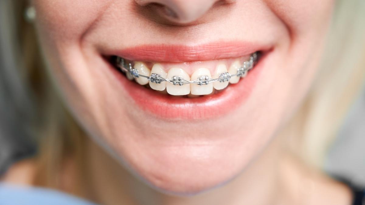 femeie cu aparat dentar