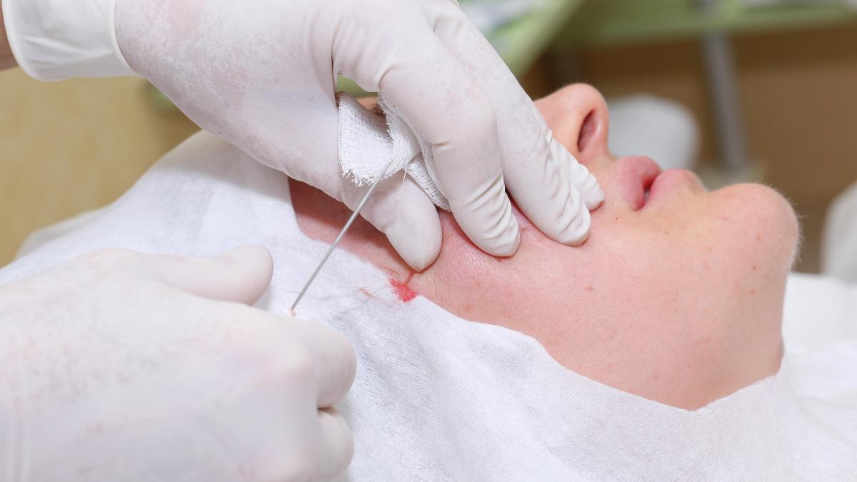 reactia societatii de chirurgie estetica dupa ce o femeie a murit in urma unui mini lifting facial