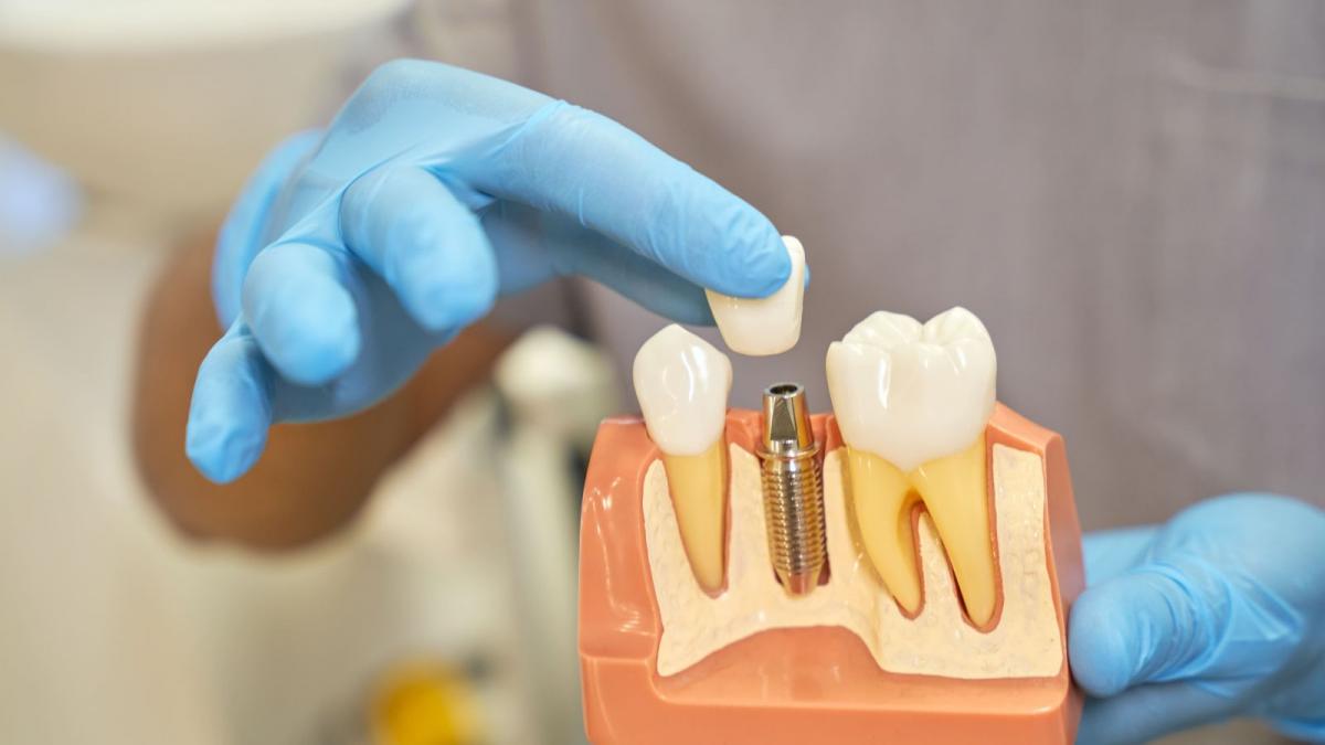 cat costa un implant dentar premium in 2026 si ce include pretul