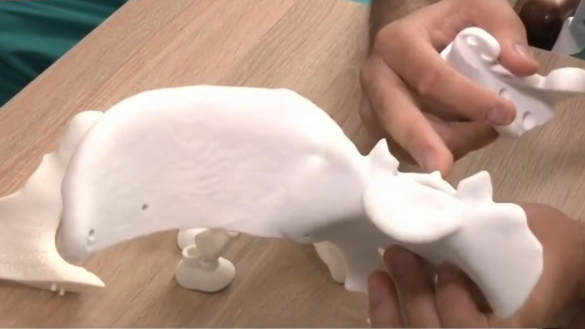 performanta medicala uriasa la oradea bazinul unei femei a fost reconstruit din bucati de titan printate 3d