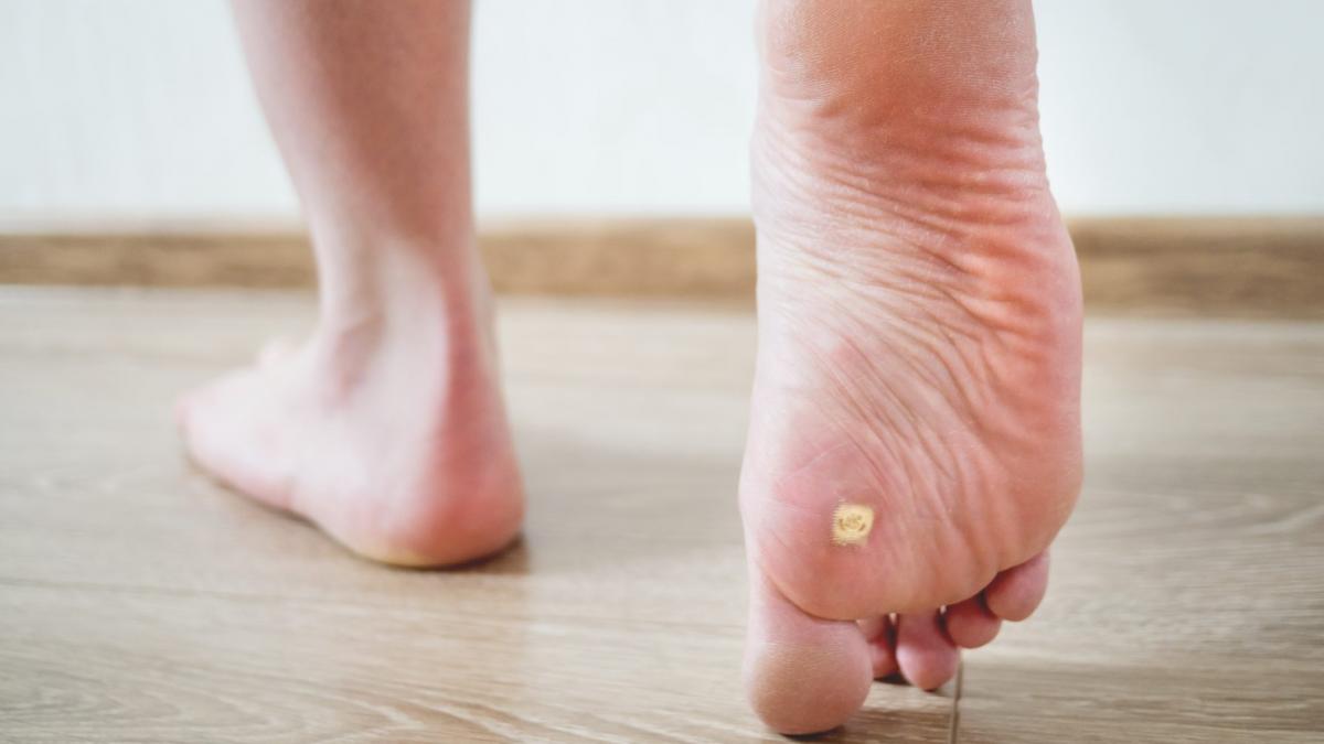 remediul natural care te scapa de negi medic dermatolog se pot retrage fara niciun alt tratament