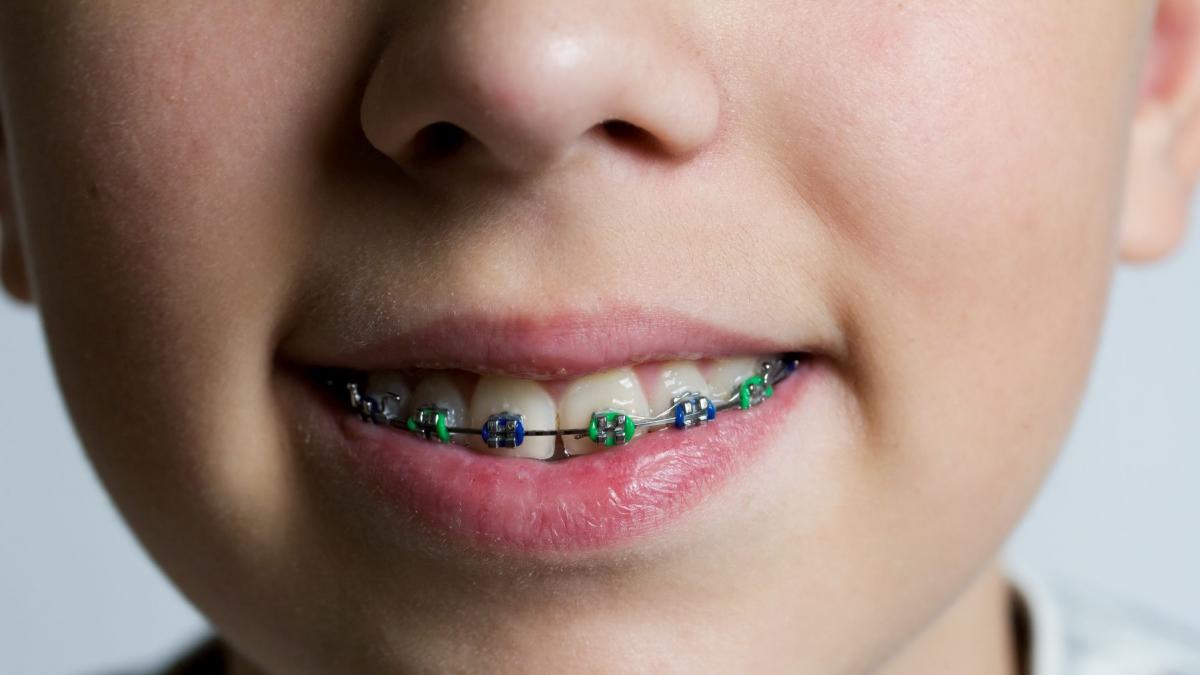 fata unui baiat care poarta aparat dentar