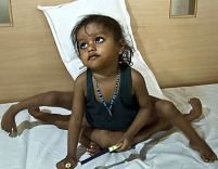 India. O fetiţă cu 4 mâni şi 4 picioare este operată

