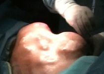 Tumoră gigant, extirpată de la un pacient al Spitalului Militar din Capitală (IMAGINI ŞOCANTE)