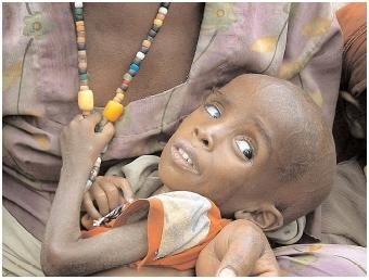 Oferă un ajutor copiilor cu malnutriţie severă din regiunea africană Sahel. Vezi aici cum poţi salva o viaţă