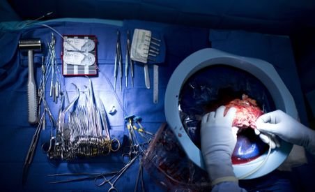 România riscă procedura de infringement în Sănătate. Legea transplantului trebuie &quot;reparată&quot;