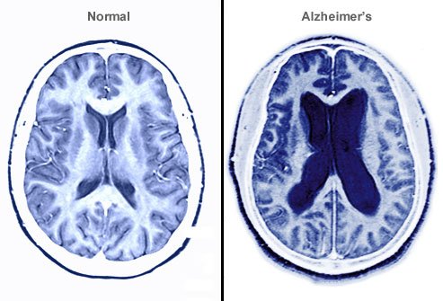 Aşa se vindecă maladia Alzheimer. Cercetătorii au găsit metoda