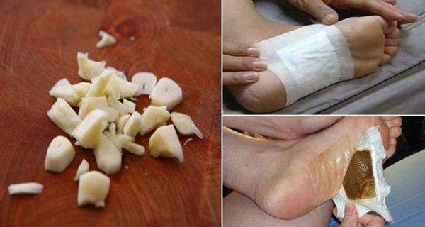 detoxifiere cu ceapa la picioare)