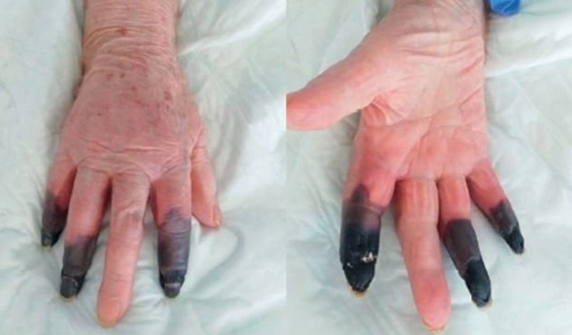 Doctorii i-au amputat trei degete după ce s-a infectat cu SARS-CoV-2
