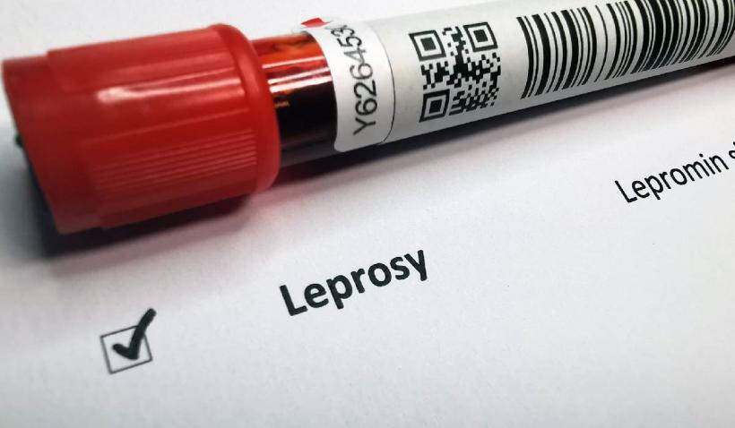 Ce știm cu adevărat despre lepră. Care sunt simptomele, cum se transmite, tratamentul și situația din România