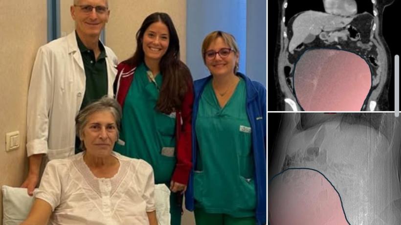 Tumoare ovariană de 6 kilograme extirpată de la o femeie, în Italia