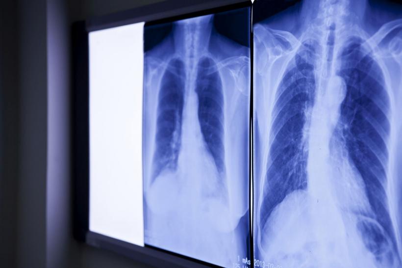 Medicii, șocați de ce au găsit în abdomenul unui bărbat care s-a prezentat la Urgențe cu dureri severe: ”E de peste 20 de ani acolo”