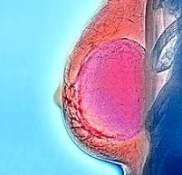 Cancerul la sân ar putea fi depistat cu ajutorul unui test de sânge
