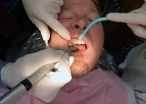 Iaşi. Un dentist amator i-a tăiat pacientului o bucată de limbă, cu freza