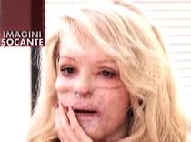 Poveste tragică: A fost violată şi desfigurată cu acid de iubitul său gelos (VIDEO)