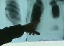 Fumătorii, mai sensibili la virusul AH1N1. Află ce complicaţii letale poate avea gripa porcină (VIDEO)
