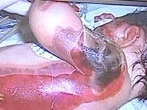 Bebeluşul uitat în incubator a fost operat, dar şansele de supravieţuire sunt mici (IMAGINI ŞOCANTE)