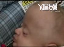 Medicii au remodelat craniul unui bebeluş care suferă de o boală genetică rară (VIDEO)