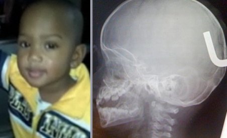 Un băieţel a supravieţuit după ce o tijă metalică i s-a înfipt în creier (VIDEO)