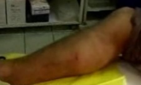 Un ieşean a ajuns la spital după ce a fost muşcat de şarpe (VIDEO)
